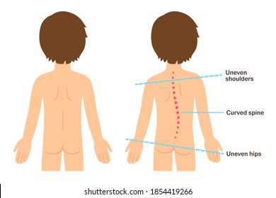 Scoliosis signs in children infographic. Child with healthy back and curved spine with uneven shoulders and hips. Flat cartoon style vector clip art illustration.