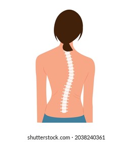 Scoliosis Spine Curve Anatomy, Posture Correction. Chiropractic treatment. Vector Illustration of back view woman representing   scoliosis and scale of curvature
