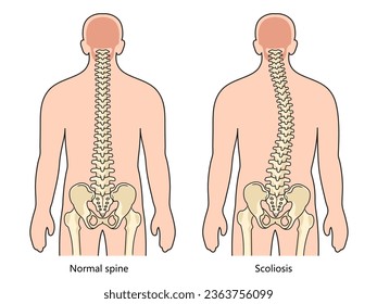 scoliosis structure scheme diagram schematic vector illustration. Medical science educational illustration