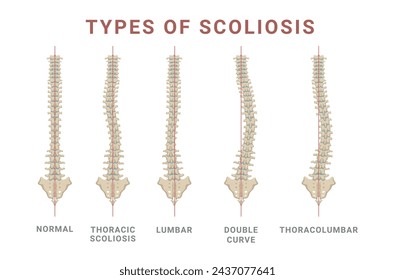 Scoliosis types spine skeleton normal and disease structure with names vector flat illustration. Human anatomy medical health care problem infographic scheme backbone spinal deformation symptom