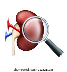 Scrutiny Kidney With Magnifying Glass. Examination Of Disease Kidney As Pyelonephritis And Renal Failure Disease, Cystitis Chronic Illness. Isolated Vector Illustration On White Background.