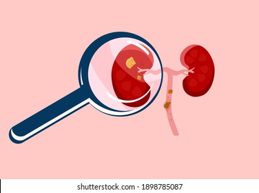 Escrutinio Piedra riñón con vidrio de aumento.Nefrología.Pielonefritis e insuficiencia renal.Inflamación en órganos, enfermedades crónicas.Vector de estilo plano