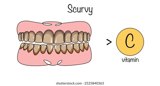 Escorbuto. Enfermedad causada por una falta de vitamina C. Dientes dañados extraídos como resultado de una falta aguda de ácido ascórbico en el cuerpo humano. Ilustración vectorial.