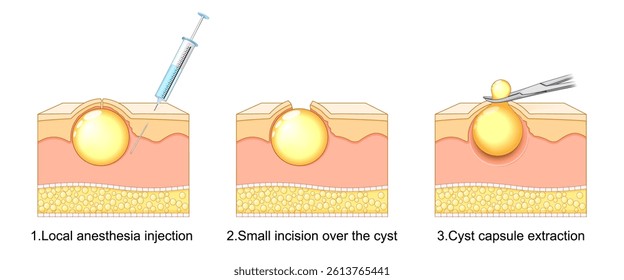 Sebaceous Cyst Removal Steps. Local anesthesia injection, small incision over the growth, and complete capsule extraction. Minimally invasive excision. trichilemmal cyst excision