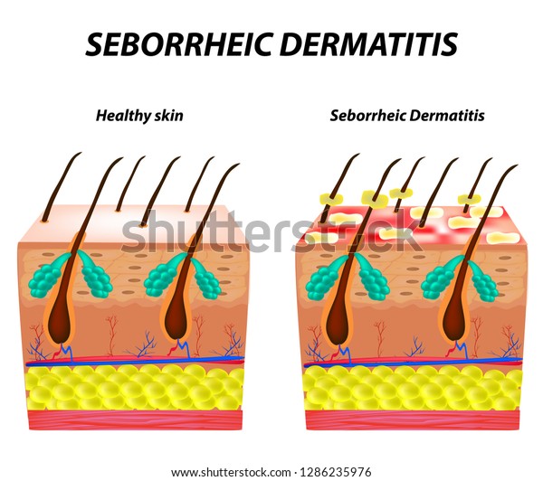 Seborrhea\
skin and hair. Dandruff seborrheic dermatitis. Eczema. Dysfunction\
of the sebaceous glands. Inflammatory skin disease. Anatomical\
structure. Infographics. Vector\
illustration.