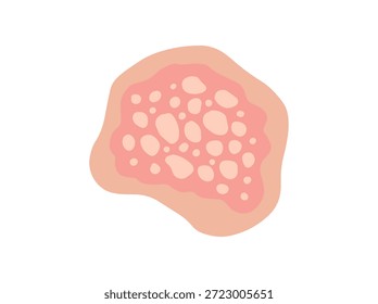 Dermatitis seborreica en la piel