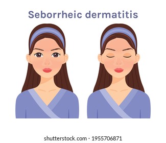 Seborrheic dermatitis. Isolated Beautiful Brunette woman. Cute face. Skin disease. Woman with open eyes and closed. White background. Color Flat cartoon illustration. Vector stock illustration.