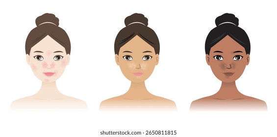 Seborrheic Dermatitis on different skin colors vector illustration. Sebderm, The rash may look redder in those with white skin and lighter or darker in people with brown or black skin.