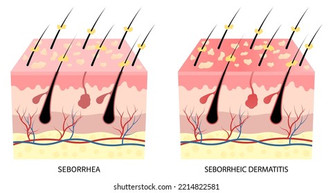 Seborrheic dermatitis on face and hair loss inflamed flake cradle cap itchy allergy shampoo health