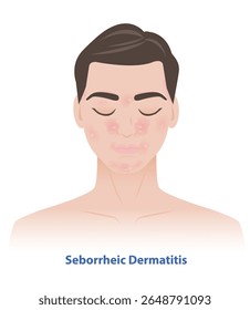 Dermatite seborreica na ilustração do vetor da face humana. Sebderm, pele inflamada, manchas escamosas, flocos sobre as áreas oleosas da face, sobre as sobrancelhas, lados do nariz, área da barba, orelhas, pálpebras.