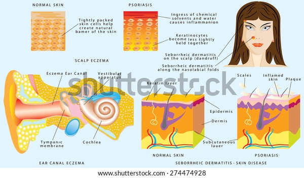 Seborrheic Dermatitis Skin Disease Ear Canal Stock Vektorgrafik Lizenzfrei 274474928 