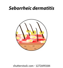 Seborrheic Dermatitis Skin Hair Dandruff Seborrhea Stock Vector ...