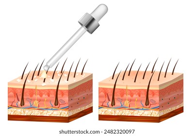 Seborrhoeic dermatitis. Before and after treatment.