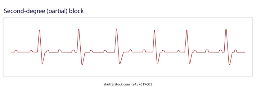 In a second-degree or partial block, one-half of the P waves are not followed by the QRS complex 