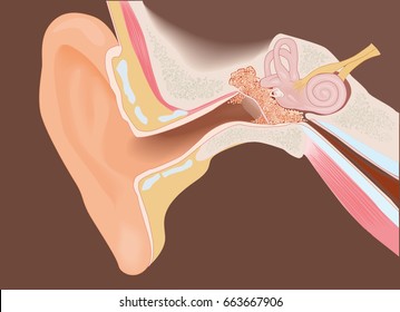 Sección del oído con colesteatoma - diagrama de color completo