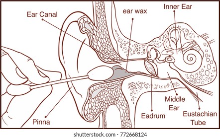 Section of the ear with the earwax - colorful diagram