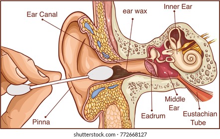 Section of the ear with the earwax - colorful diagram