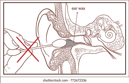 Section of the ear with the earwax - colorful diagram