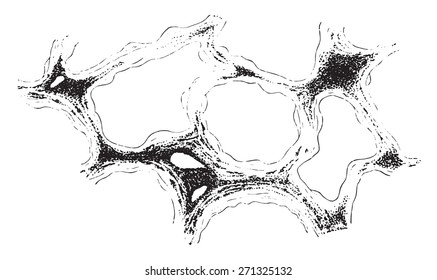 Section of the lung, pneumoconiosis, vintage engraved illustration. 