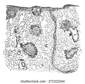 Section of lung showing chalicosis, vintage engraved illustration. 