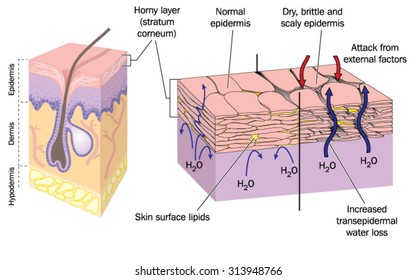 Section through skin showing normal epidermis and skin surface structure resulting in water loss and dry, brittle, scaly skin