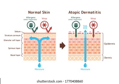 Sectional View Atopic Dermatitis Normal Skin Stock Vector (Royalty Free ...