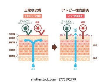 Sectional view of atopic dermatitis and normal skin / Comparative vector illustration. Translation: Normal skin, Barrier function, Allergens(mites/house dust), Virus, Sebum, Stratum corneum etc.