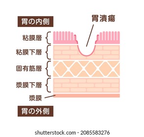 Sectional view illustration  of gastric ulcer. Translation: Inside, Tumor, Mucosa, Submucosa, Muscle, Subserosa, Serosa, Outside, Ulcer.
