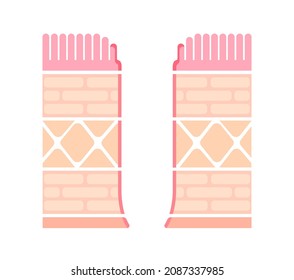 Sectional view illustration  of perforated ulcer 