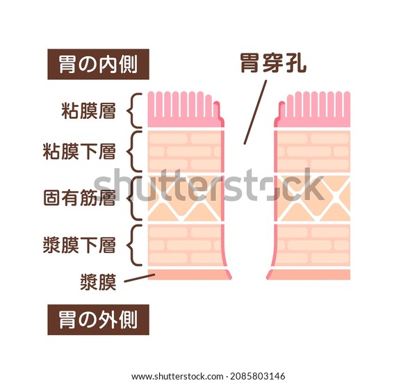 Sectional view illustration  of perforated ulcer.\
Translation: Inside, Tumor, Mucosa, Submucosa, Muscle, Subserosa,\
Serosa, Outside, Perforated\
ulcer.