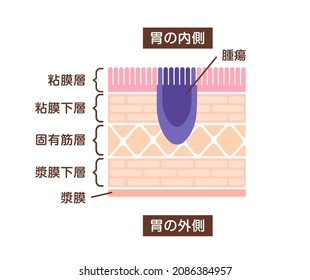 Sectional view illustration of stomach cancer (gastric cancer) . Translation: Inside, Tumor, Mucosa, Submucosa, Muscle, Subserosa, Serosa, Outside.