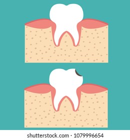 Sectional view tooth decay. Human with caries. Dental health problem and healthy