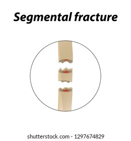 Segmental fracture Bone. Infographics. Vector illustration on a lined background.