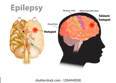 Seizures Epilepsy - Seizure Hotspot. Medical Illustration Of A Brain With Epilepsy