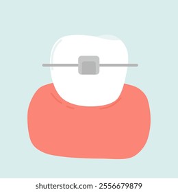 Self Ligating Orthodontic Braces Illustration