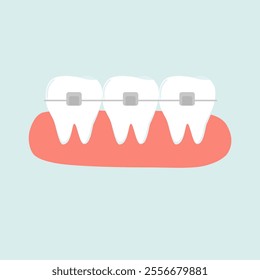 Self Ligating Orthodontic Braces Illustration