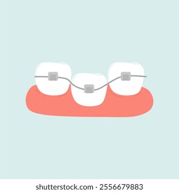 Self Ligating Orthodontic Braces Illustration