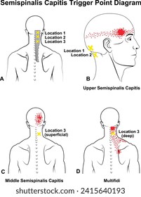 Semispinalis Capitis Trigger Point Vector Diagram