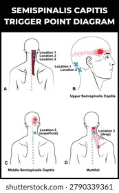Semispinalis Capitis trigger points vector diagram