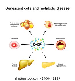 Senescent cells and metabolic disease. Senescence-associated secretory phenotype SASP. Senescent cells promote insulin resistance, liver steatosis, muscle atrophy and Sarcopenia, hyperinsulinemia