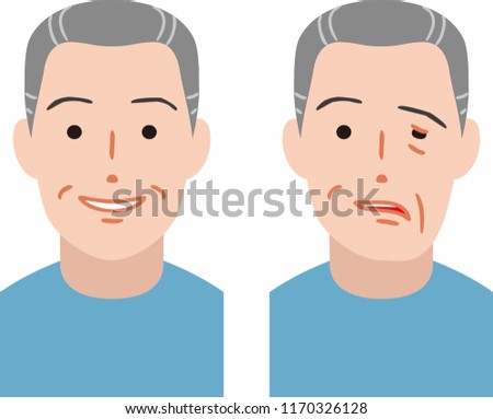 Senior citizen of facial nerve palsy