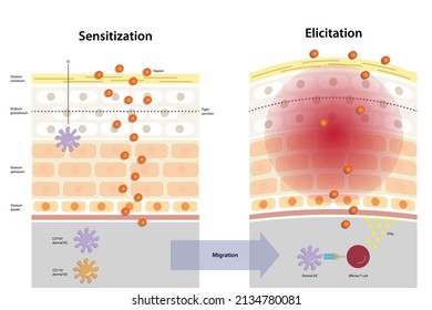 Sensitization and elicitation phases in contact allergy. Allergic contact dermatitis, contact hypersensitivity, cell–mediated inflammatory skin diseases induced by contact allergens (haptens)