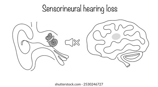 Perda auditiva neurossensorial. Uma doença do ouvido interno caracterizada por inflamação do nervo vestibular ou cóclea. Problema com a área de percepção auditiva do cérebro. Ilustração vetorial.