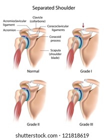 Separated shoulder