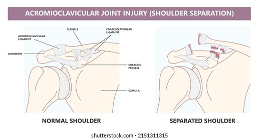 Separation dislocation the AC joint fall shoulder bump bruise torn cuff tear nerve bone broken Trauma pain arc arm sport medicine Neer FOOSH test Grade X ray Brace arthroscopy recovery range of motion