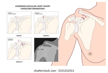 Art der Schulter Acromioclavicular (AC) Gemeinsame Trennung, die schmerzhafte Symptome