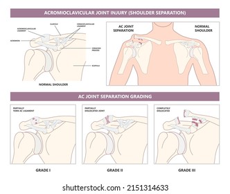 Separation dislocation the AC joint fall shoulder bump bruise torn cuff tear nerve bone broken Trauma pain arc arm sport medicine Neer FOOSH test Grade X ray Brace arthroscopy recovery range of motion