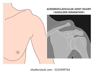 Separation dislocation the AC joint fall shoulder bump bruise torn cuff tear nerve bone broken Trauma pain arc arm sport medicine Neer FOOSH test Grade X ray Brace arthroscopy recovery range of motion