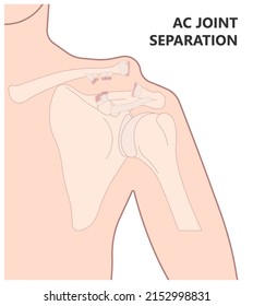 Separation dislocation the AC joint fall shoulder bump bruise torn cuff tear nerve bone broken Trauma pain arc arm sport medicine Neer FOOSH test Grade X ray Brace arthroscopy recovery range of motion