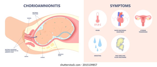 Sepsis Birth Preterm Atony Baby Intra Bacteria Women Water Breaks Labor Fetus Fluid Mother Poly Microbial Disease Urinary Tract E. Coli Genital Vagina Uterus Health Group B Strep Amnion Fetal System